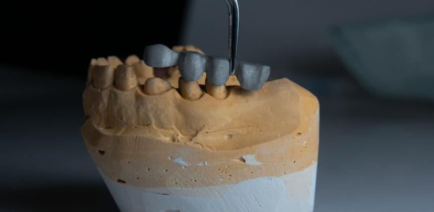 corone dentali